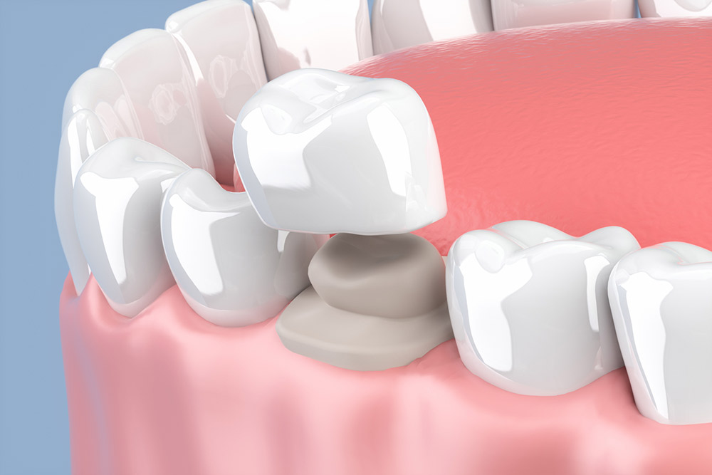 人工の歯を装着