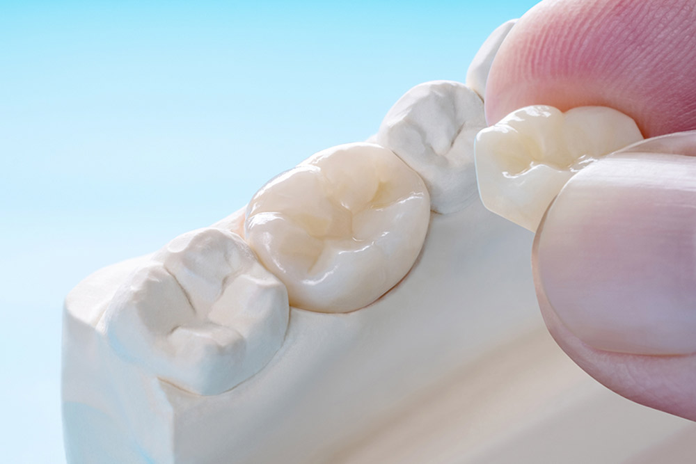 つめ物やかぶせ物を装着